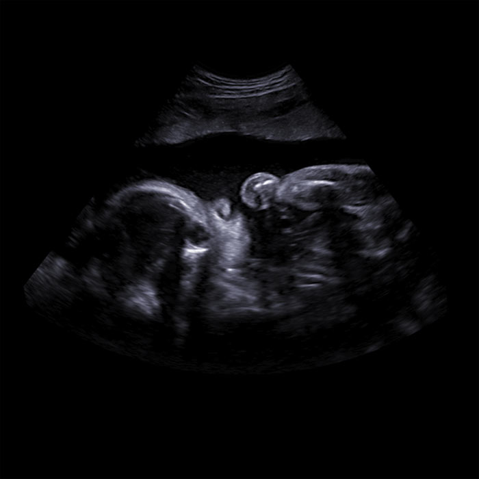 2D Ultrasound